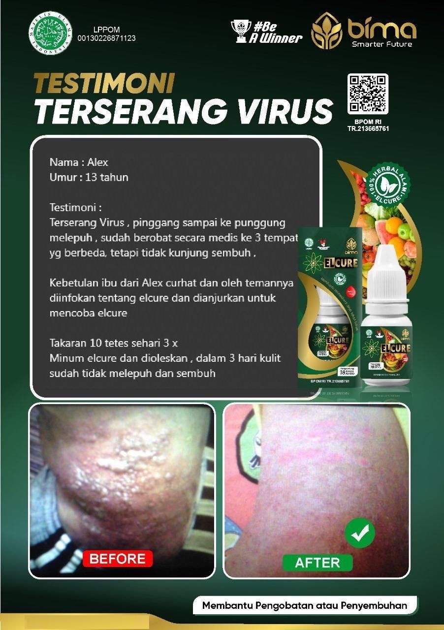 testimoni elcure terserang virus